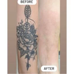 Bonsai Tattoo Removal Frisco clinic photo