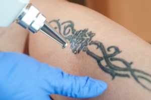 Laser-tattoo-removaL